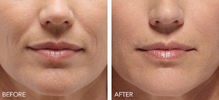Before and after Belotero Balance: smile lines and lines around the mouth are visibly softened after treatment