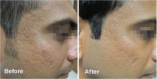 Before and after Fractora: acne scarring on a man's cheek is visibly reduced after treatment