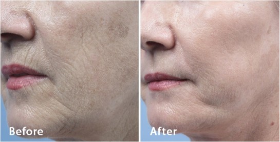 Before and after Fractora: deep wrinkles around the mouth and cheek are visibly smoother after treatment