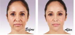 Before and after Juvéderm Ultra Plus XC: smile lines and folds around the nose and mouth are visibly smoother