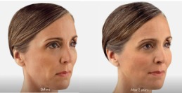 Before and after Juvéderm Voluma XC: flattened cheek area is lifted and more contoured