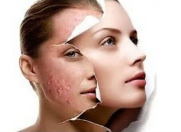 Illustration of microdermabrasion revealing smooth, clear skin beneath rough, blemished skin