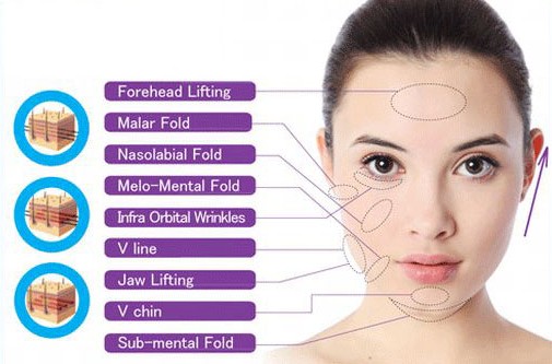 Face diagram of PDO thread treatment areas: forehead lifting, malar fold, nasolabial fold, melo-mental fold, infra-orbital wrinkles, V line, jaw lifting, V chin and sub-mental fold