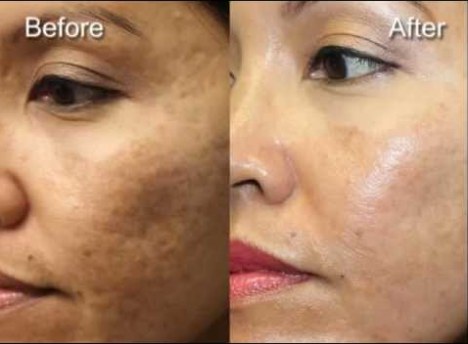 Before and after photo rejuvenation: dark patches and uneven pigment on the cheek appear clearer and more even after treatment