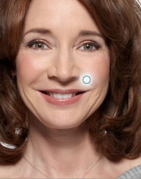 Smiling woman's face with numbered markers on the five Radiesse treatment areas