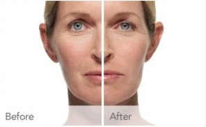Before and after Radiesse: the treated half of the face shows softer smile lines and restored volume