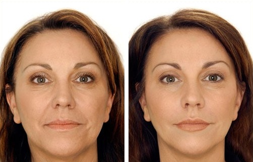 Before and after Restylane: smile lines and lines around the mouth are visibly softer after treatment
