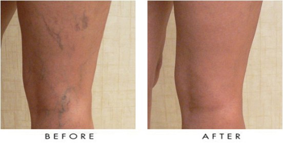 Before and after sclerotherapy: visible spider and varicose veins on the back of the leg have faded after treatment